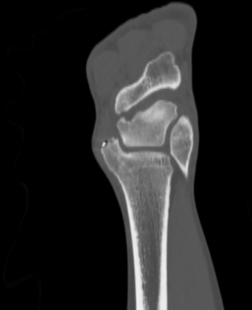 April 2025 DICOM-derived coronal CT slice