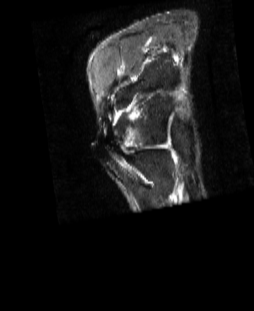 October 2025 DICOM-derived coronal MRI STIR MARS slice
