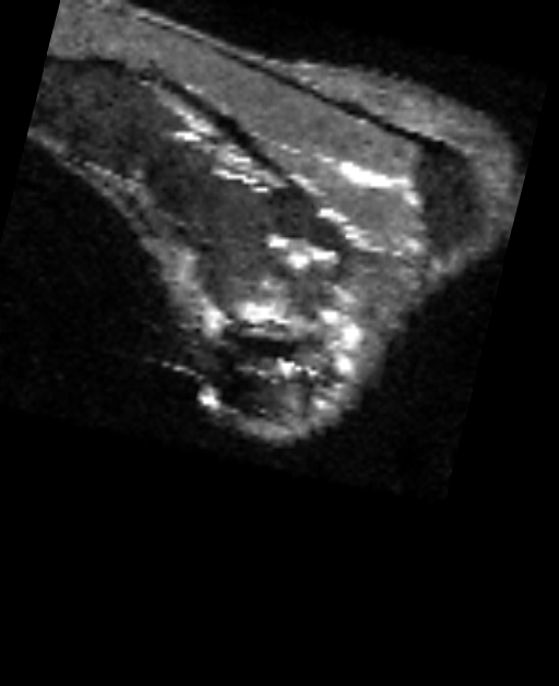 October 2025 DICOM-derived sagittal MRI STIR MARS slice